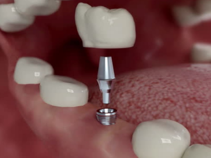 Implantacija zobnih vsadkov je lahko dobrodošla alternativa protezam ali mostičkom, ki se ne prilegajo dobro in lahko ponudi možnost, ko pomanjkanje naravnih zobnih korenin ne omogoča izdelave protez ali nadomestkov z mostičkom.